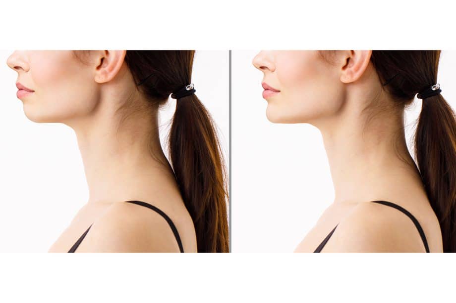 HOW FIXING YOUR “ORAL POSTURE” RESTORES FIRMNESS TO YOUR FACE