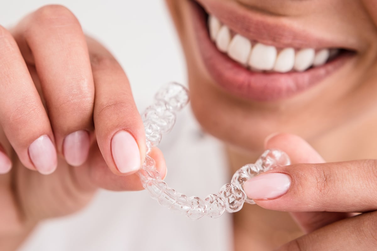 How Much Does Invisalign Cost in Missouri?