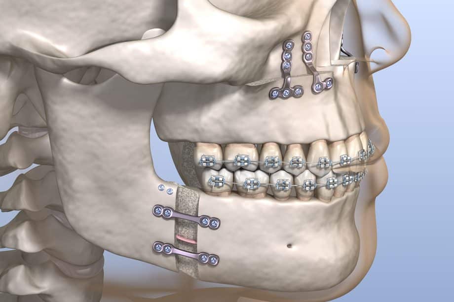 How Much Does Orthognathic Surgery Cost in Missouri?