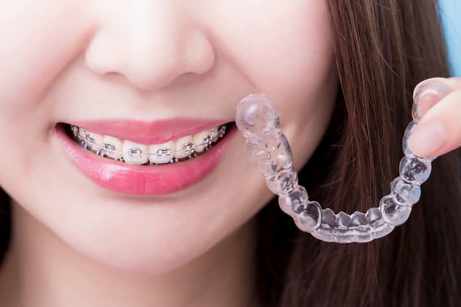 What Can You Eat With Braces?